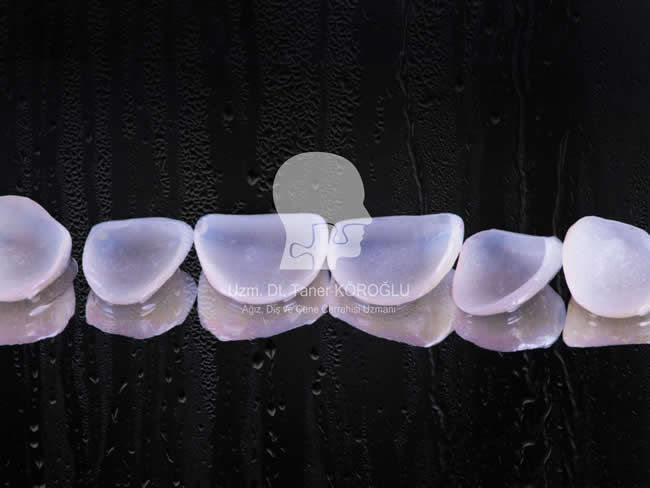 Porselen Lamina Tedavisi - Bursa Diş Polikliniği